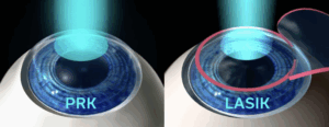 What Is The True Difference Between PRK And LASIK?